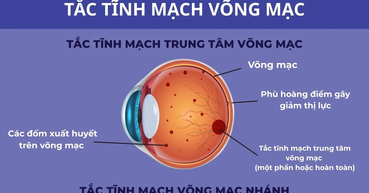 Tắc tĩnh mạch võng mạc